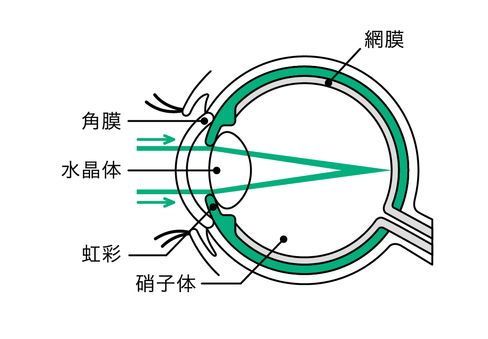 焦点眼内レンズ