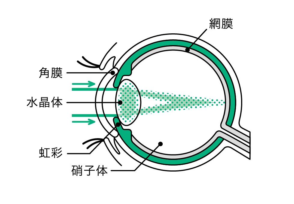 焦点眼内レンズ