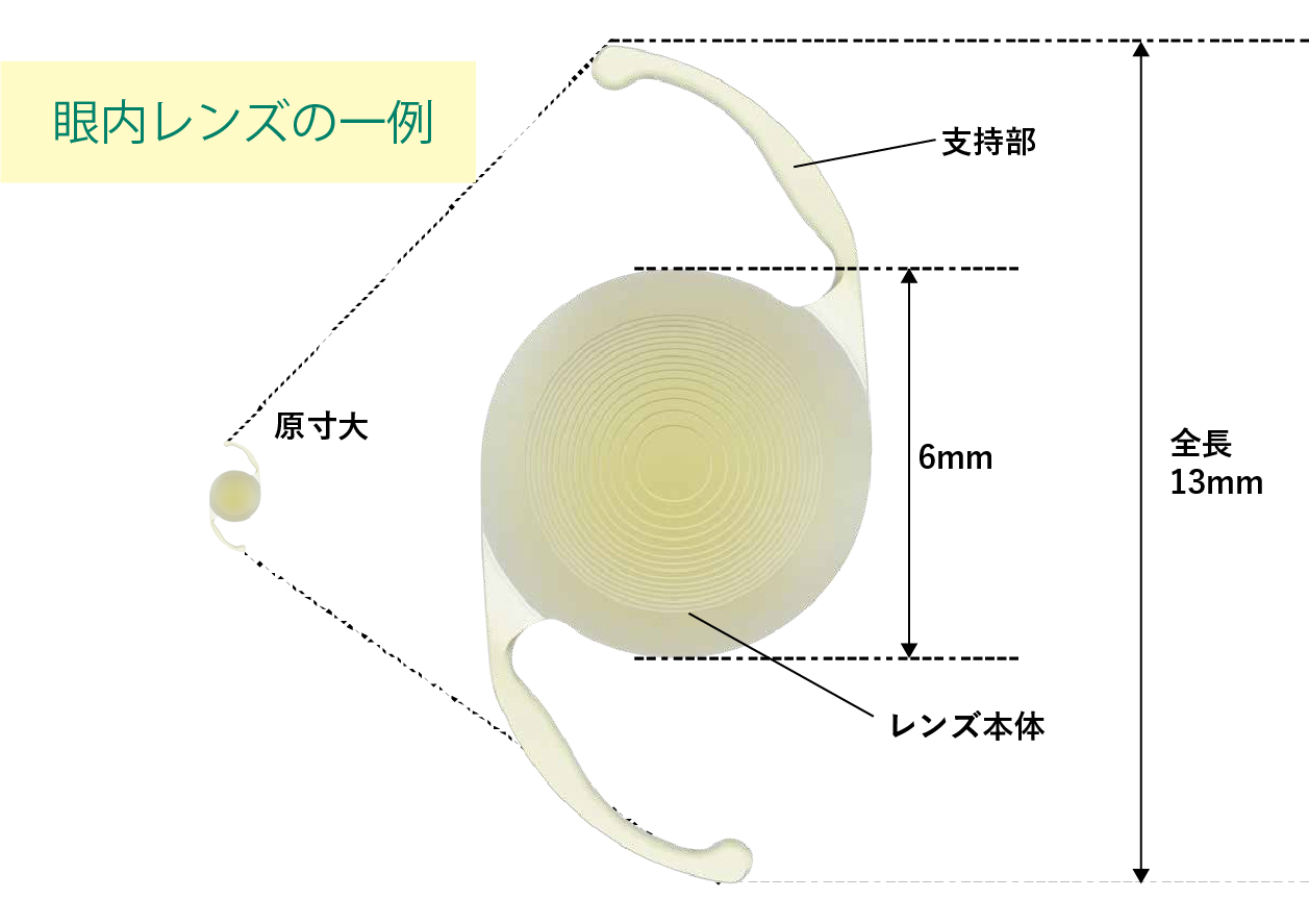 焦点眼内レンズ